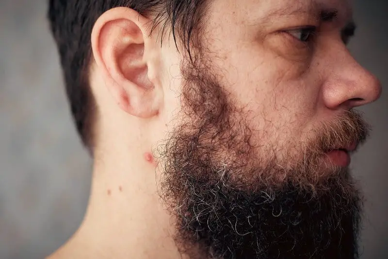 How to Get Rid of Beard-Related Pimples