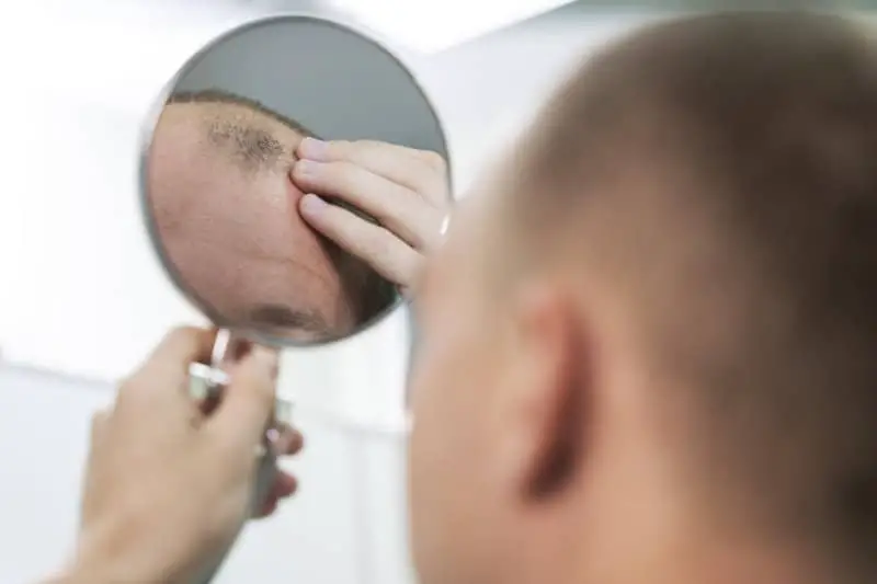 How Finasteride Can Treat Androgenetic Alopecia