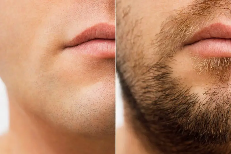Will Growth Hormone Help To Improve Your Beard