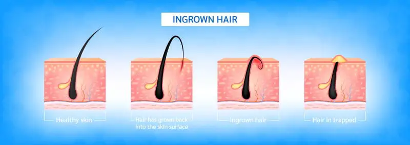 What’s Ingrown Hair All About