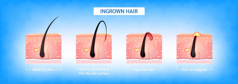 What’s Ingrown Hair All About